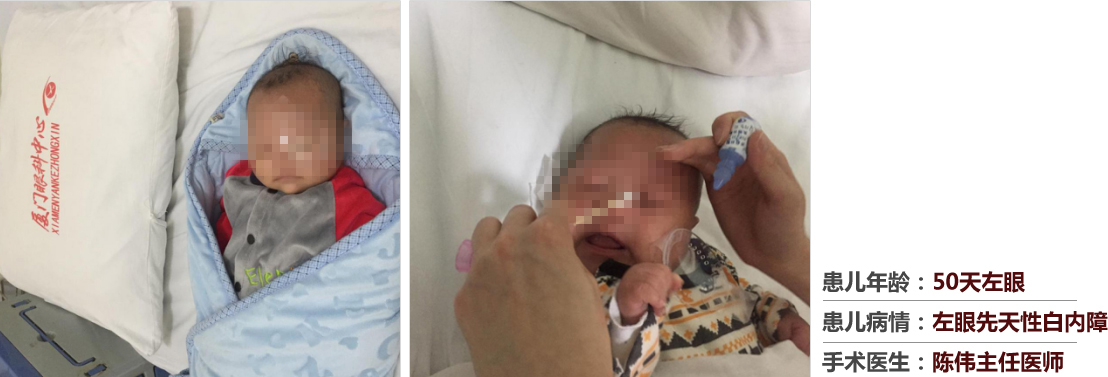 患兒年齡：50天左眼，患兒病情：左眼先天性白內(nèi)障，手術(shù)醫(yī)生：白內(nèi)障科陳偉主任醫(yī)師
