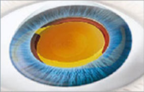 第4步:晶體展開手術完成