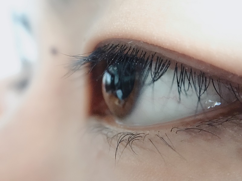 上眼皮為什么會下垂？上瞼下垂是怎么引起的？