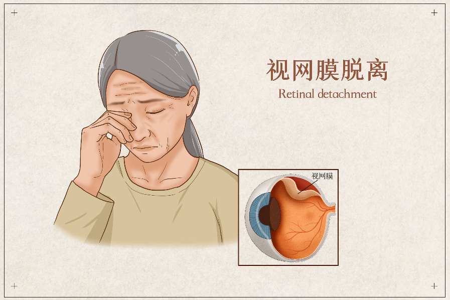 治療視網(wǎng)膜