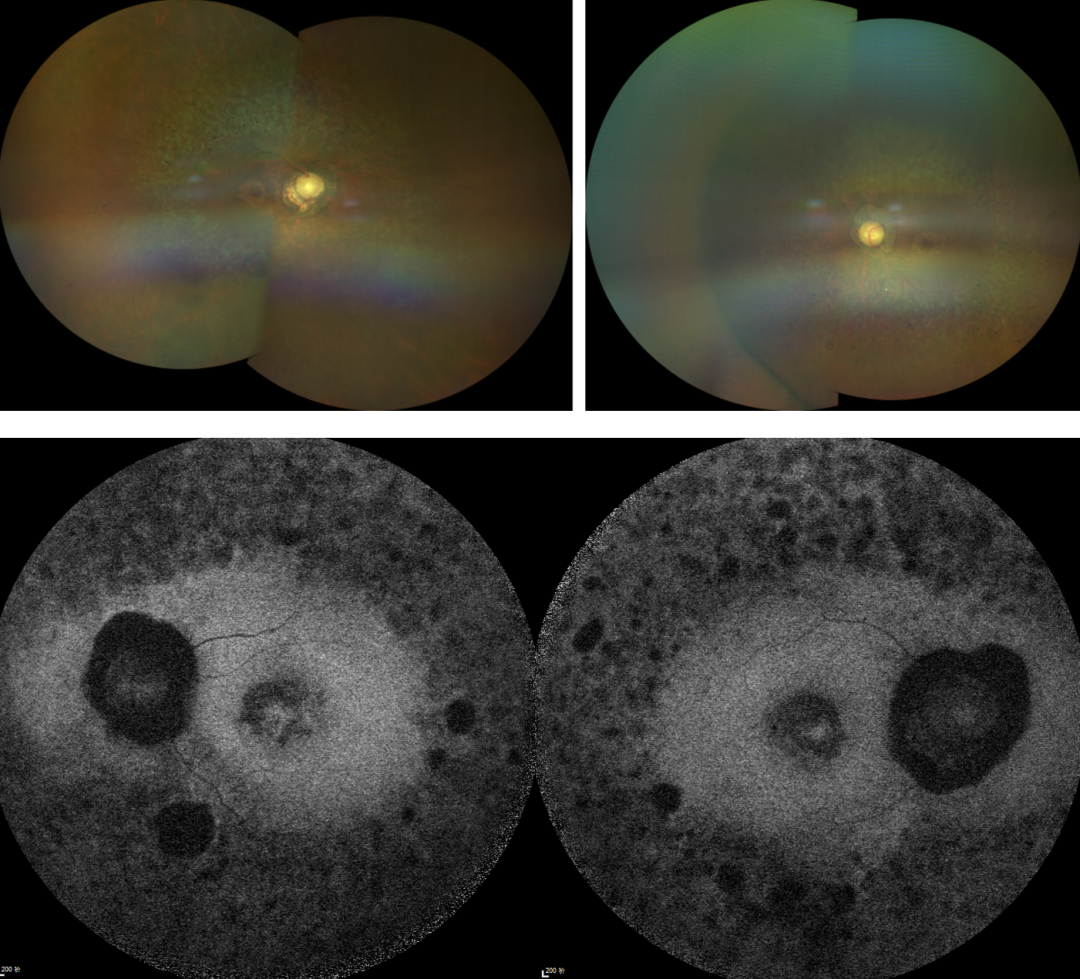 視網(wǎng)膜色素變性