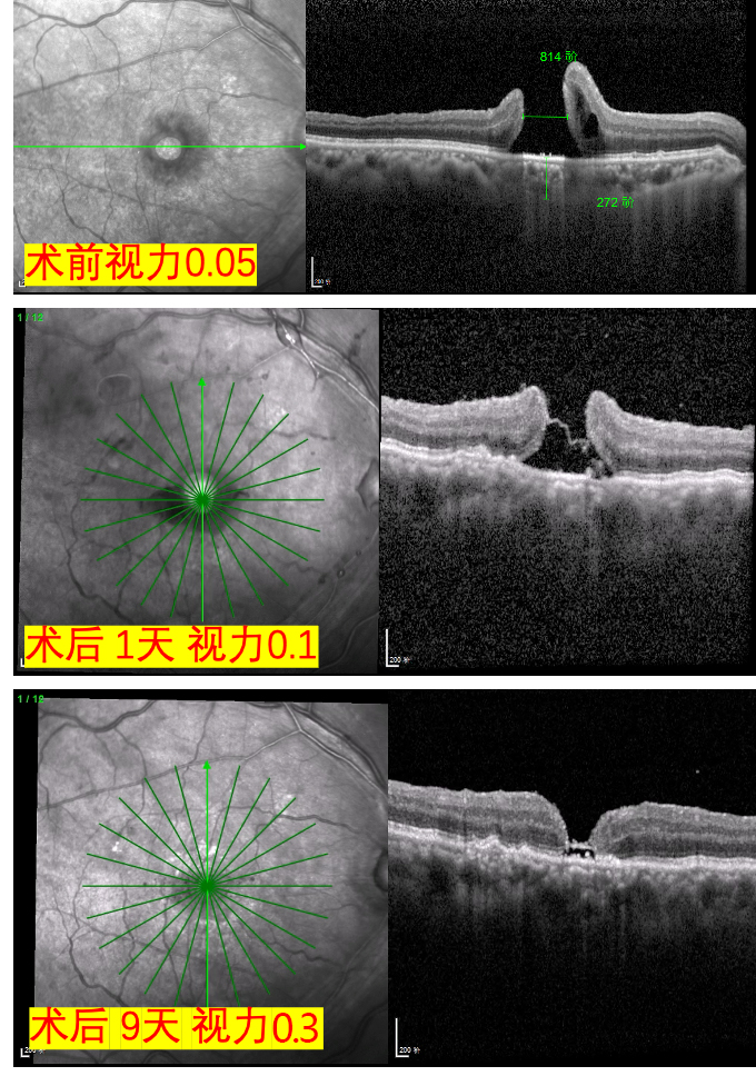 黃斑裂孔