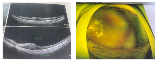 視網(wǎng)膜脫離