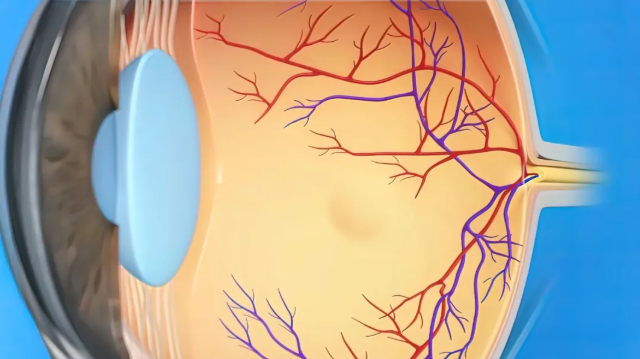 糖尿病視網膜病變